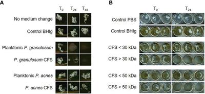 Propionibacterium (Cutibacterium) granulosum Extracellular DNase BmdE Targeting Propionibacterium (Cutibacterium) acnes Biofilm Matrix, a Novel Inter-Species Competition Mechanism